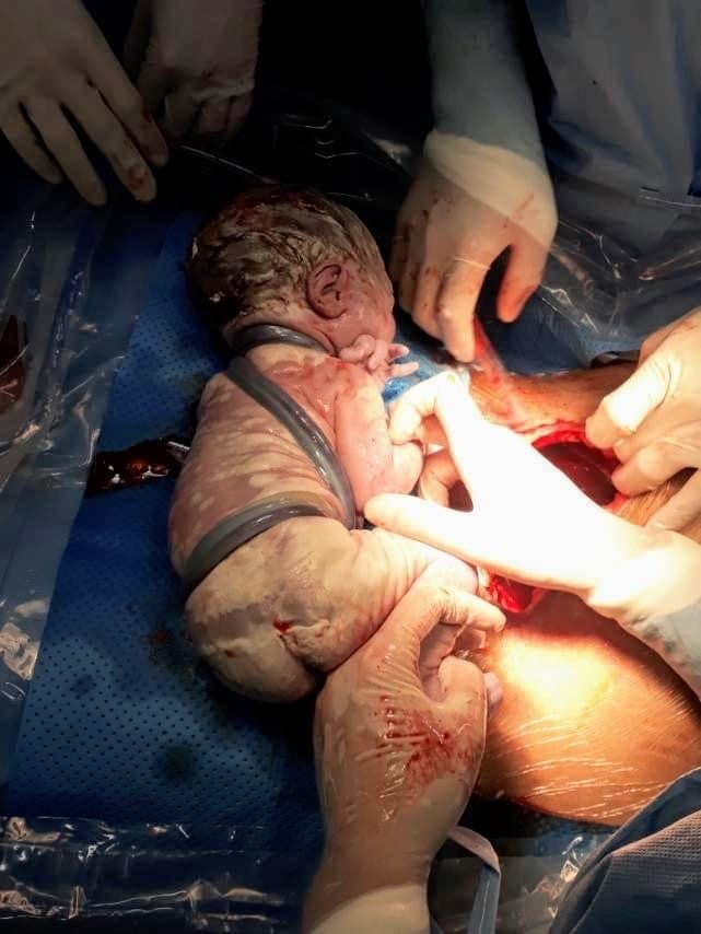A newborn is pictured tightened by six rounds of umbilical cord upon his arrival at Hung Vuong Hospital in District 5, Ho Chi Minh City, May 22, 2020 in this photo uploaded on the infirmary's verified Facebook page.